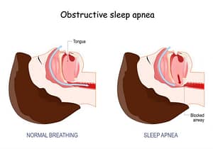 obstructive-sleep-apnea-symptoms