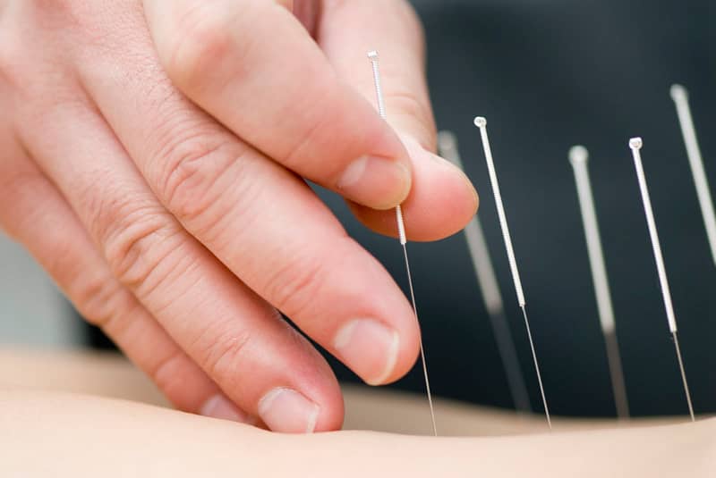 Natural Healing Through Acupuncture