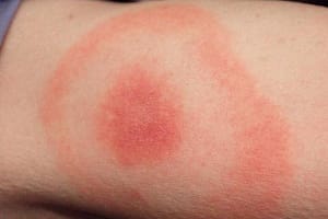 Lyme Disease Bulls Eye Rash